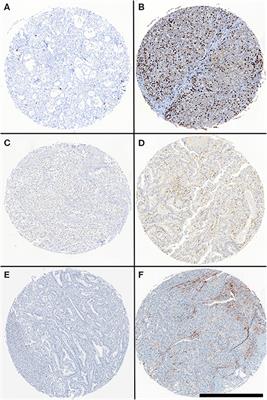 Low Expression of Programmed Death 1 (PD-1), PD-1 Ligand 1 (PD-L1), and Low CD8+ T Lymphocyte Infiltration Identify a Subgroup of Patients With Gastric and Esophageal Adenocarcinoma With Severe Prognosis